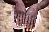 The back of the hands of a patient with monkeypox showing a characteristic rash during his recovery phase.
